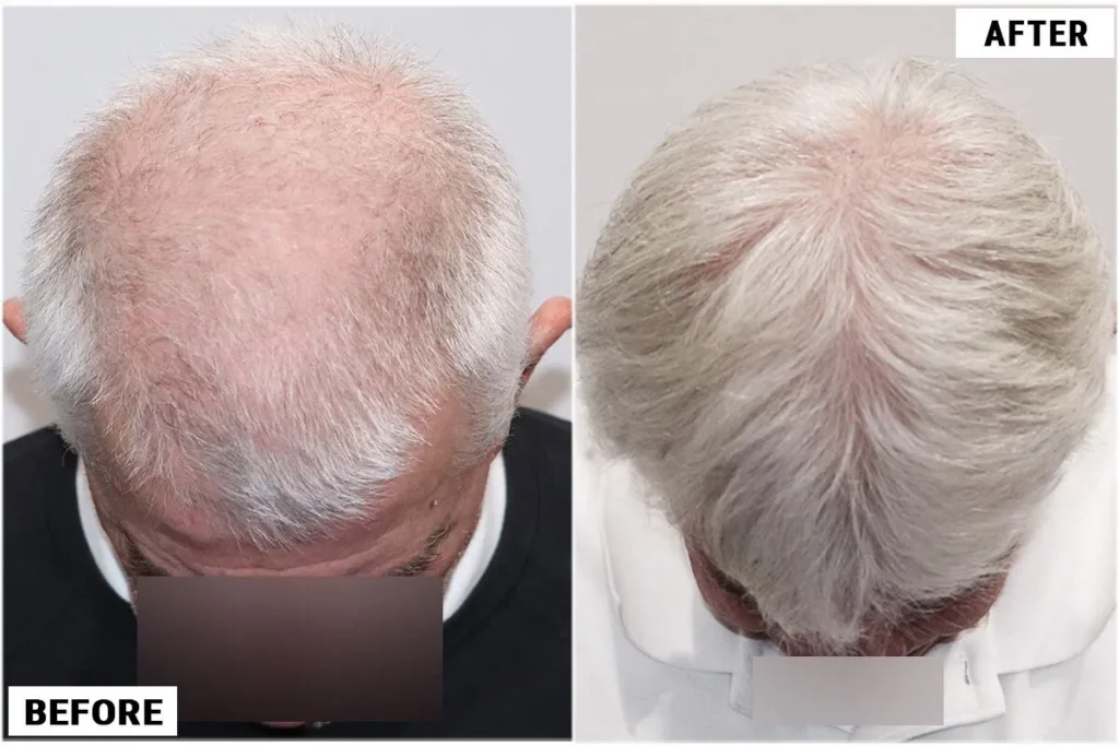 before and after results stem cells top shot