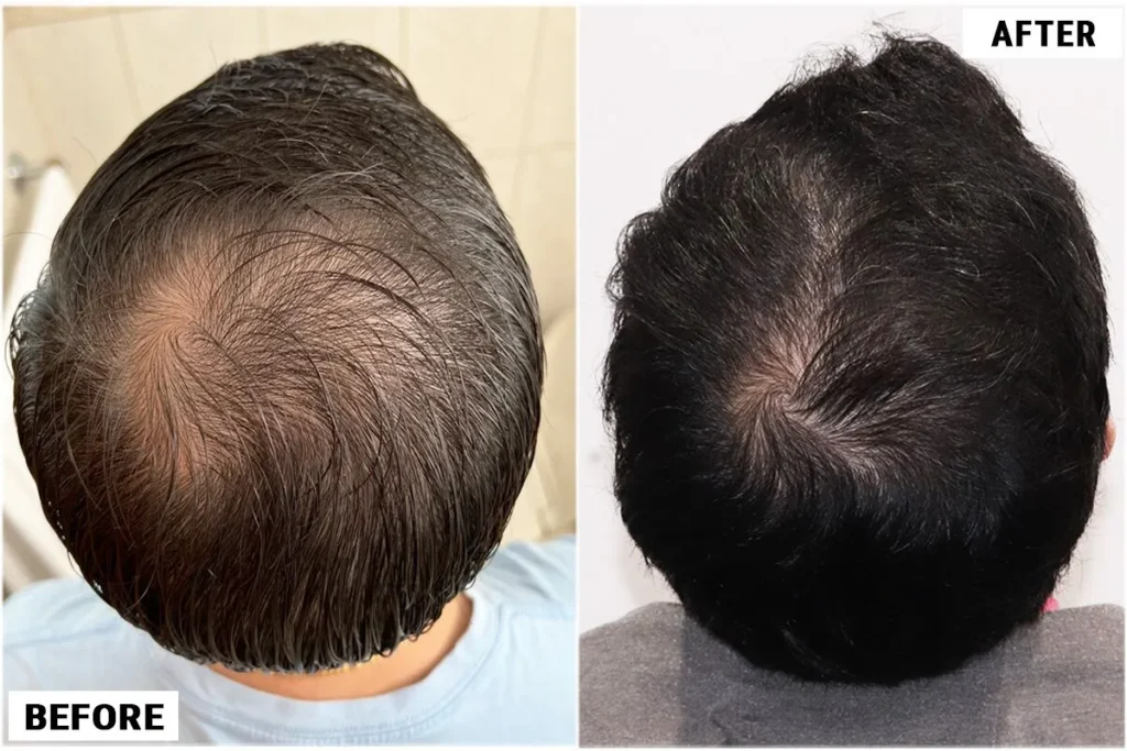 CRP before and after results on male's crown