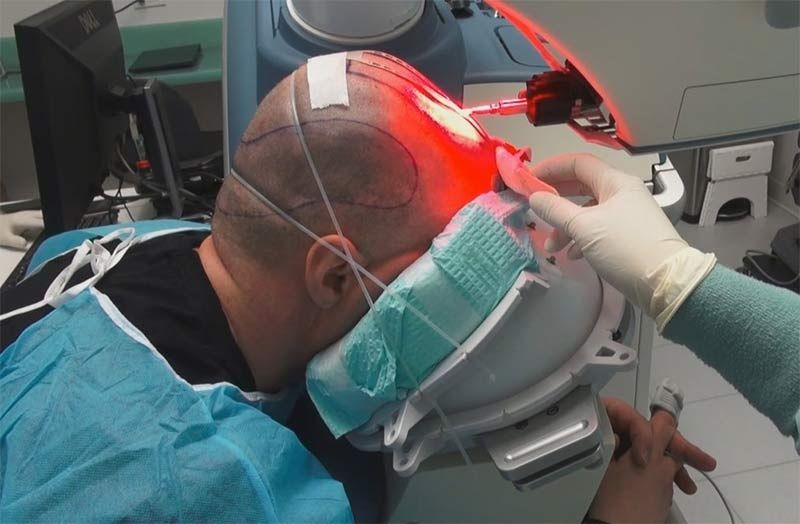 Robotic hair transplant