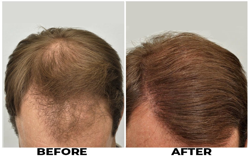 Hair Transplant 4698 grafts FUE