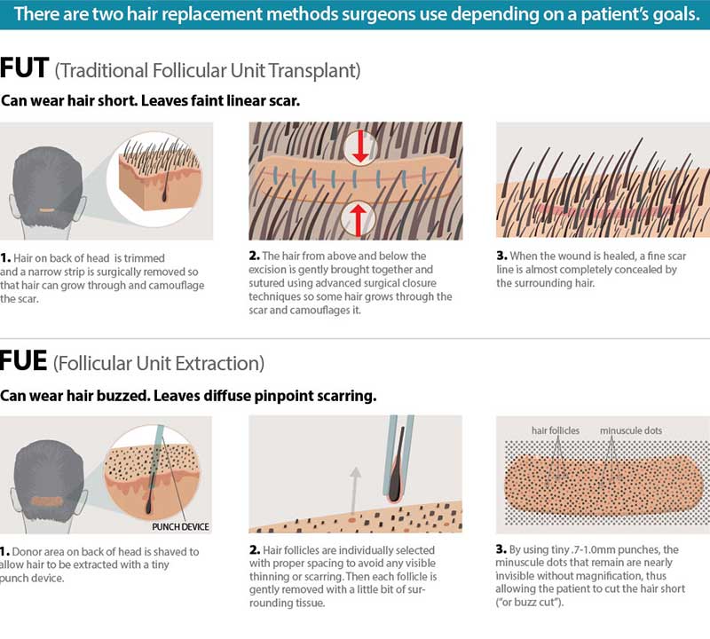 fue hair transplant vs fut forhair1