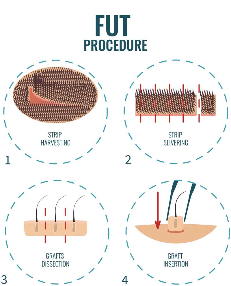 fue hair transplant vs fut hair transplant forhair6