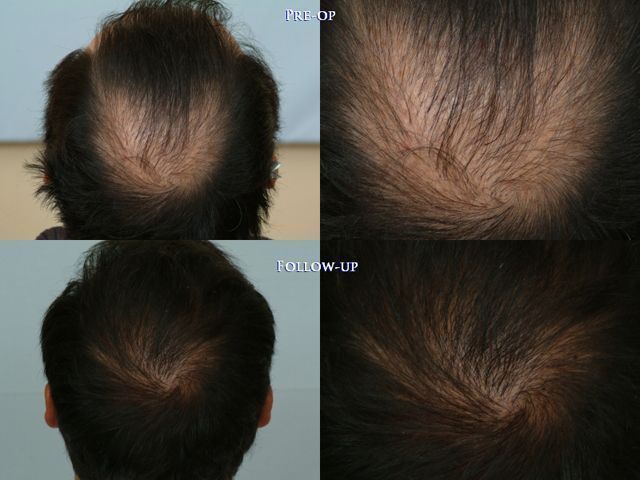 case 2 before after crown