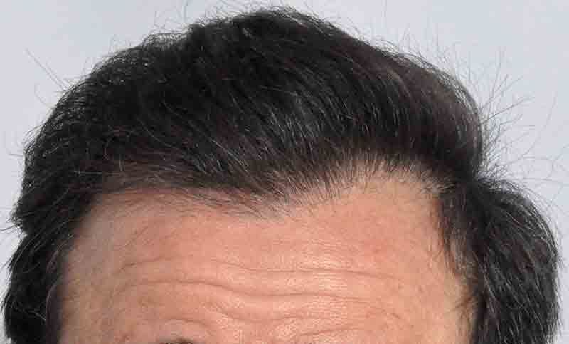 case 11 hairline