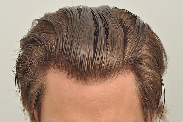 Forhair's patient perfect hairline