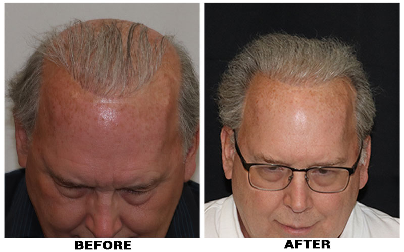 Hair Transplant 3000 grafts FUE