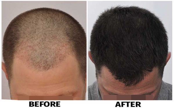 Patient EEE before & after FUE results featured photo