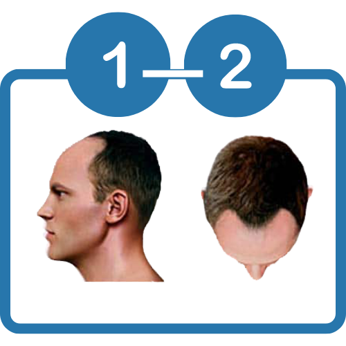 MPB Type 1-2 Norwood Scale