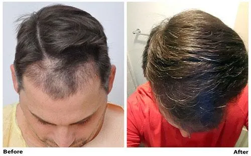 Hair Transplant Stories, Forhair