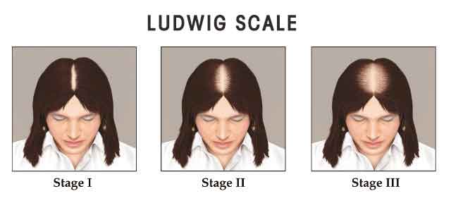 Ludwig Scale - Pattern Baldness for Woman