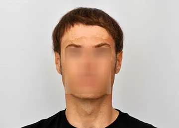 After FUE hair restoration
