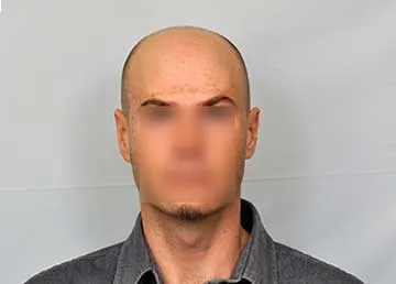 Before FUE hair restoration