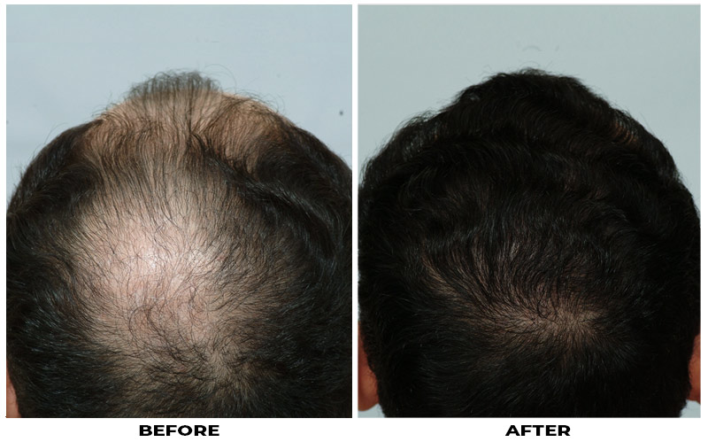 Hair Transplant 2501 grafts FUE