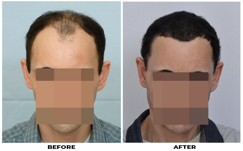 Hair Transplant 2501 grafts FUE