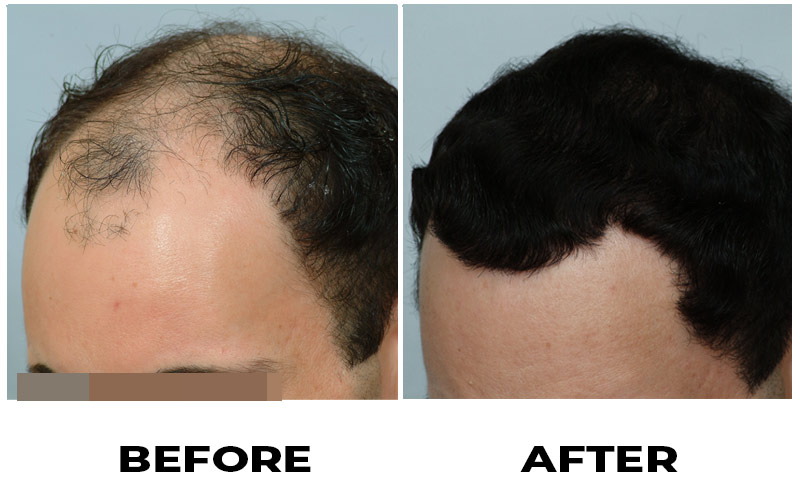Hair Transplant 2501 grafts FUE