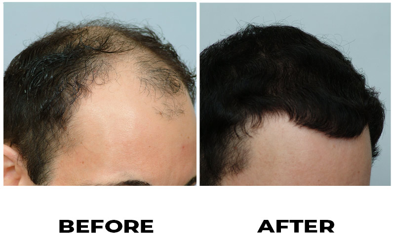 Hair Transplant 2501 grafts FUE