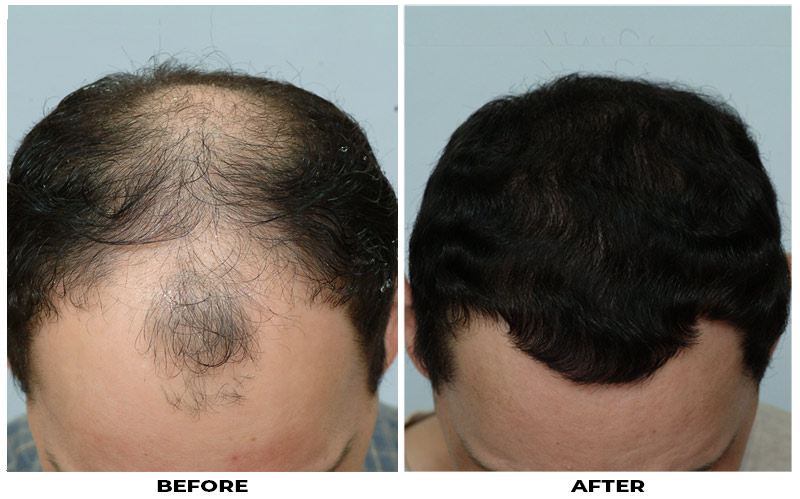 Hair Transplant 2501 grafts FUE