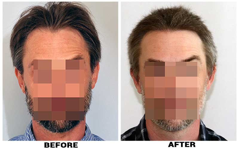 Hair Transplant 2500 grafts FUE