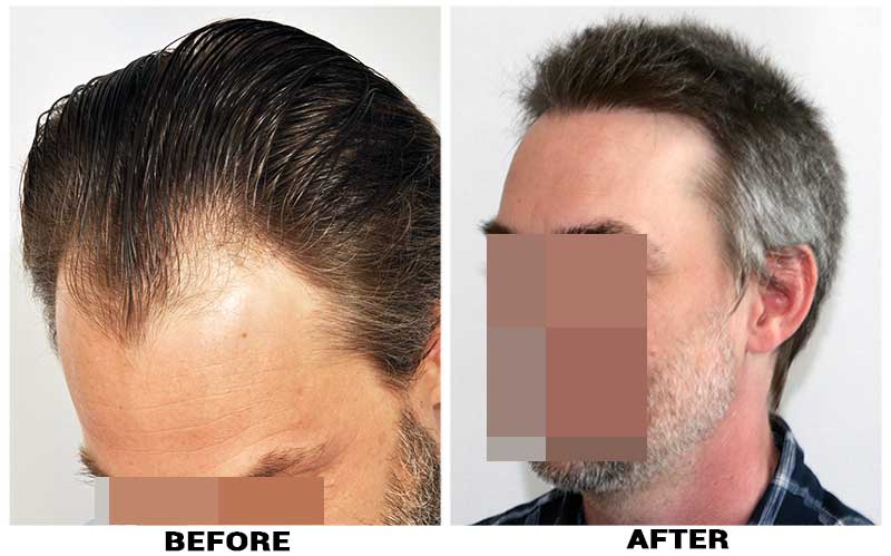 Hair Transplant 2500 grafts FUE