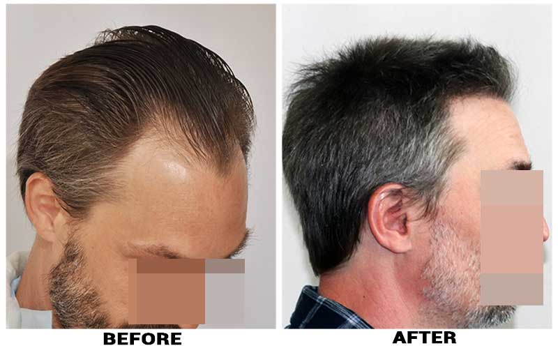 Hair Transplant 2500 grafts FUE