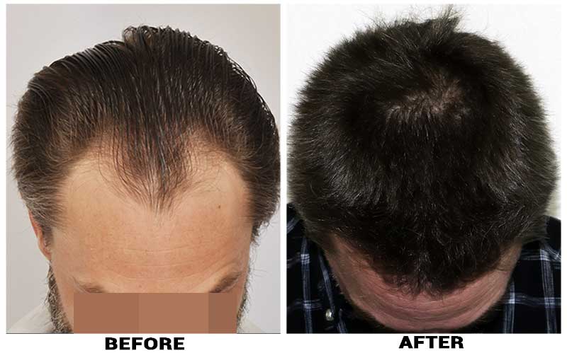 Hair Transplant 2500 grafts FUE