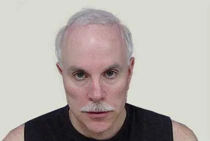 Before FUE body hair procedure