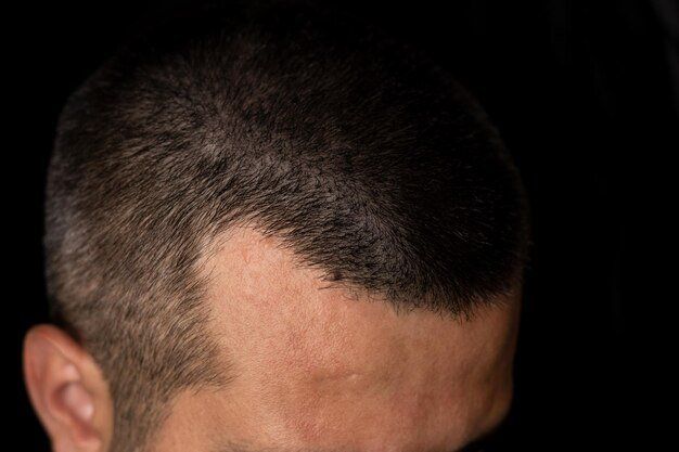 Hair growth: anegan phase