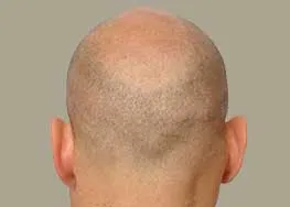 Before FUE scar repair procedure