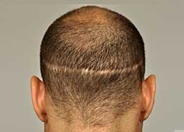 After FUE scar repair procedure