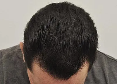 After FUE procedure