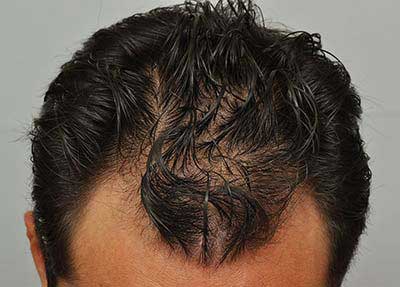 Before FUE procedure