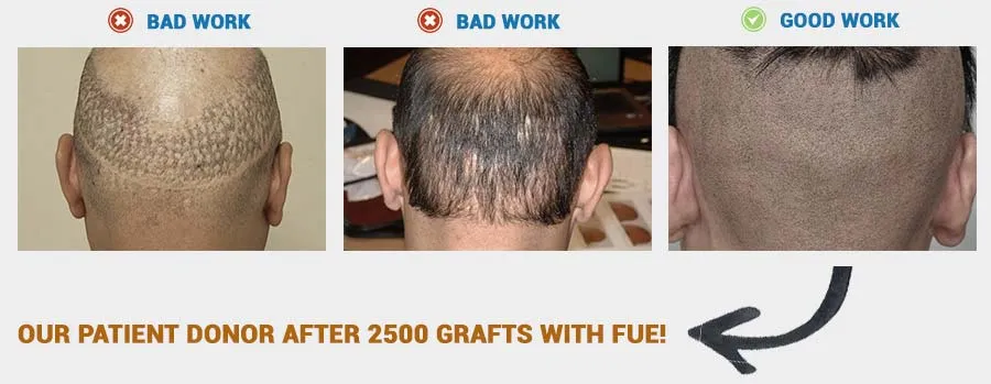Advanced FUE Hair Transplant | Dr. Cole CIT® | Forhair