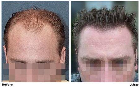Hair Transplant Patient in NYC