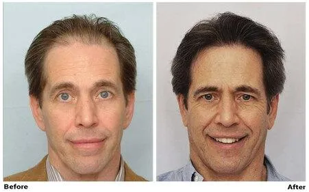 FUE Hair Transplant - CIT Patient 3