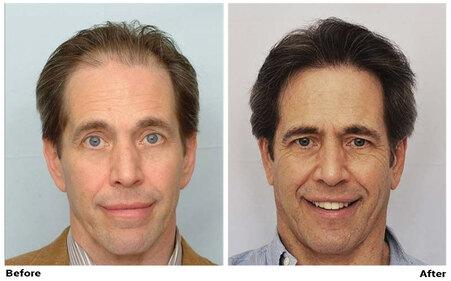 New York Hair Transplant Patient