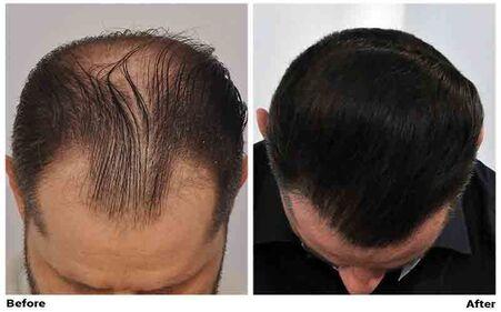 New York Hair Restauration Patient