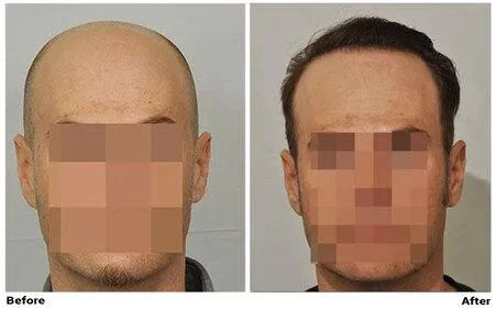 FUE Hair Transplant - CIT Patient 5