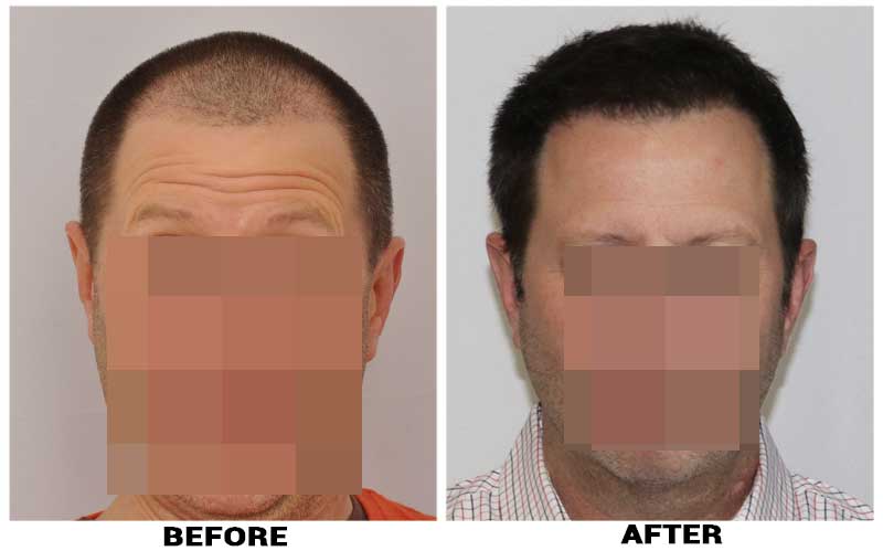 Hair Transplant 2200 grafts FUE