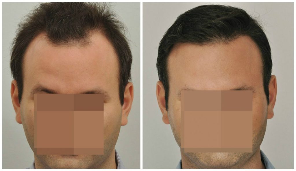 Hair Transplant 2004 grafts FUE