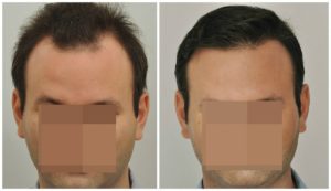 Hair Transplant 2004 grafts FUE