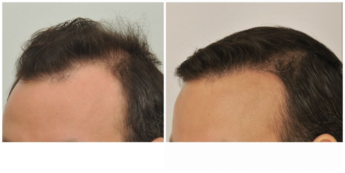 Hair Transplant 2004 grafts FUE