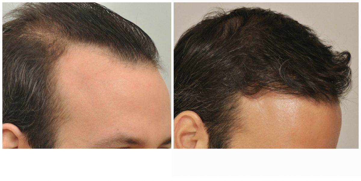 Hair Transplant 2004 grafts FUE