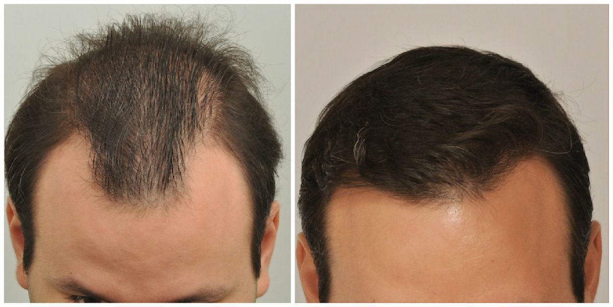 Hair Transplant 2004 grafts FUE