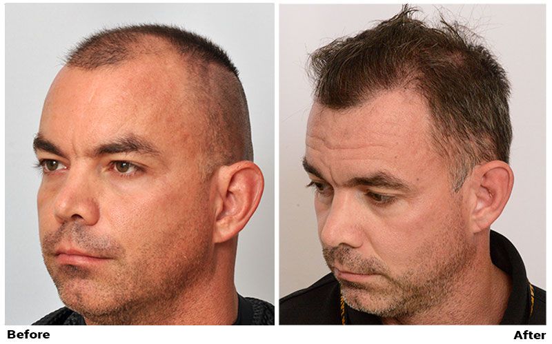 Hair Transplant 2050 grafts FUE