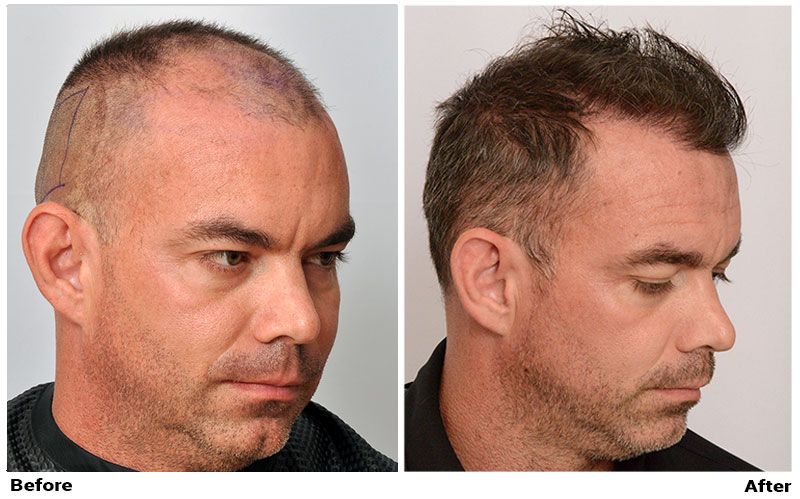 Hair Transplant 2050 grafts FUE