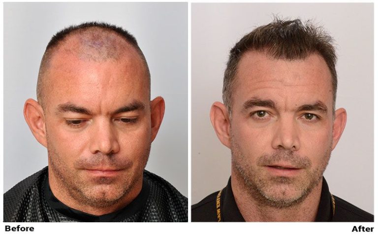 Patient MIL before & after FUE results full face comparison photo - wet hair 2