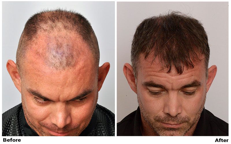 Hair Transplant 2050 grafts FUE