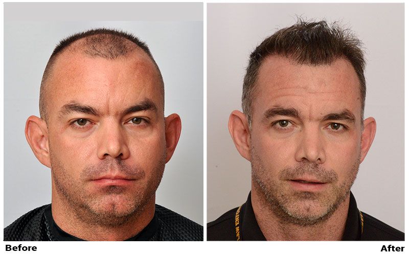 Hair Transplant 2050 grafts FUE