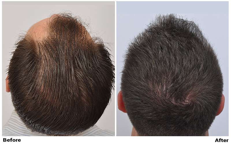 A man with a full head of hair before and after a hair transplant