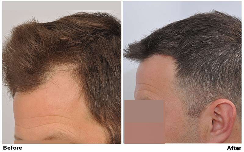 Hair Transplant 2201 grafts FUE